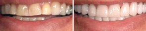 Dentistry Bite Reconstruction & Porcelain Crowns & Bridges