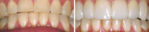 Dentistry Bite Reconstruction & Porcelain Crowns
