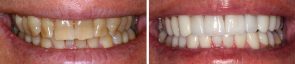 Dentistry Veneers & Crowns